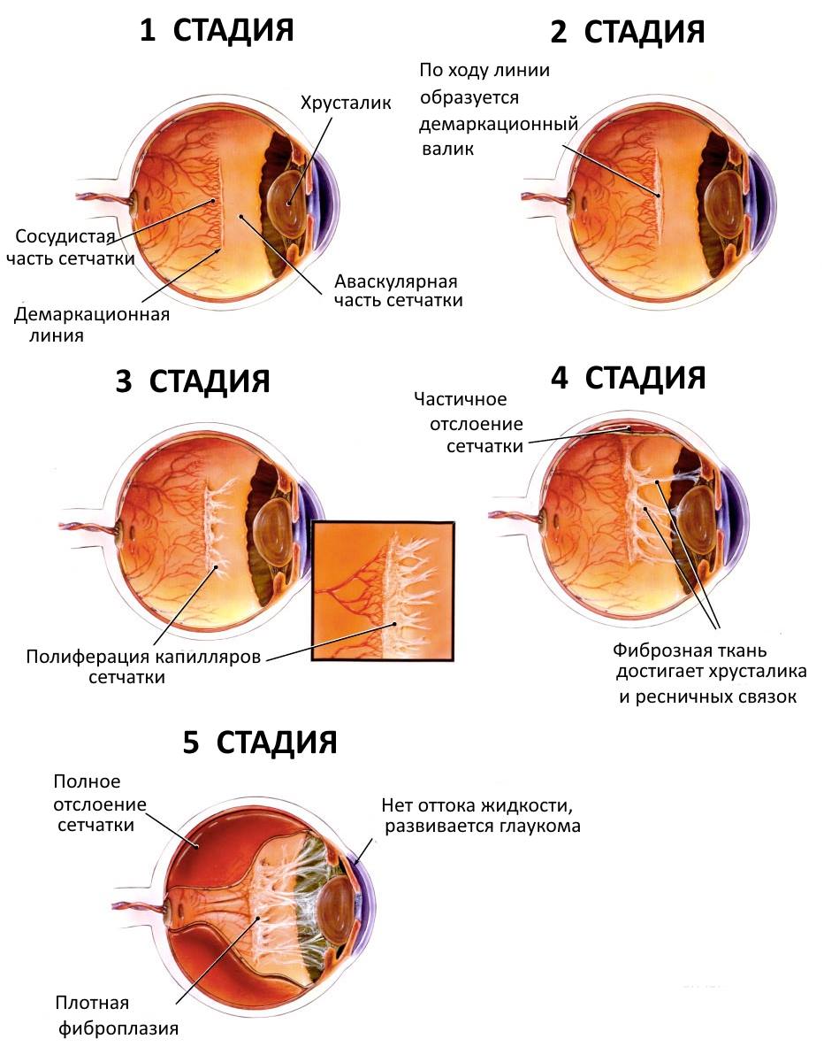 Стадии ретинопатии недоношенных