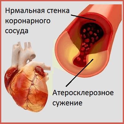 Стенокардия напряжения