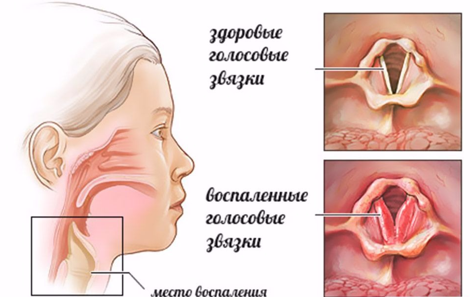 Отличия здоровых голосовых связок от воспалённых