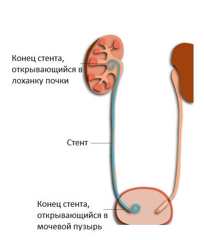 Стент в мочеточнике (схема)