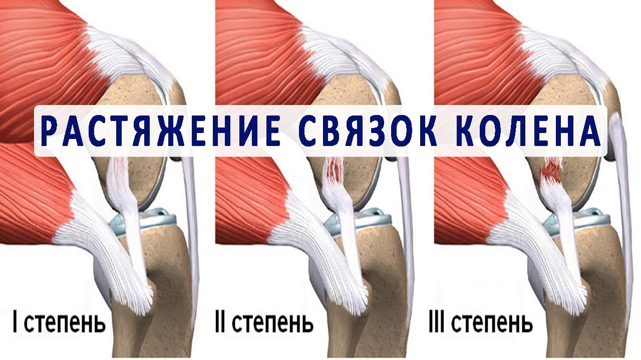 Степени растяжения коленных связок