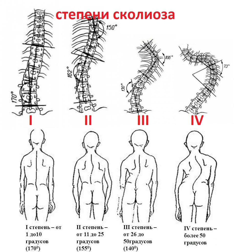 Степени сколиоза