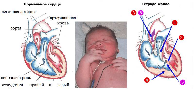 Tetrad («красная» нумерация) аномалий сердца, типичных для синюшной болезни