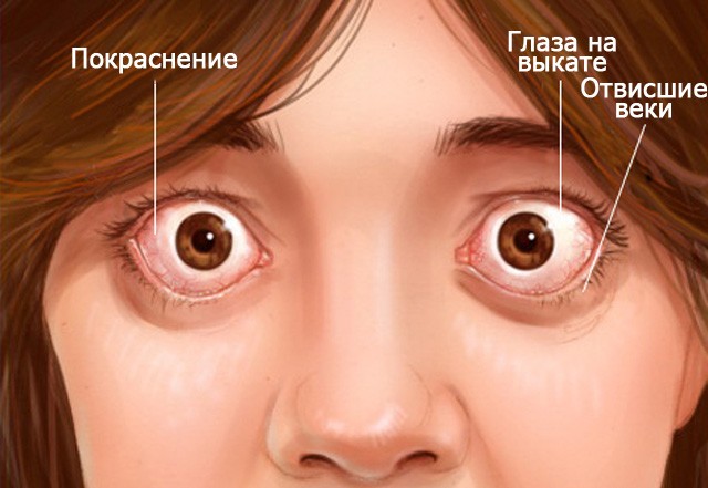 Характерные признаки эндокринной орбитопатии