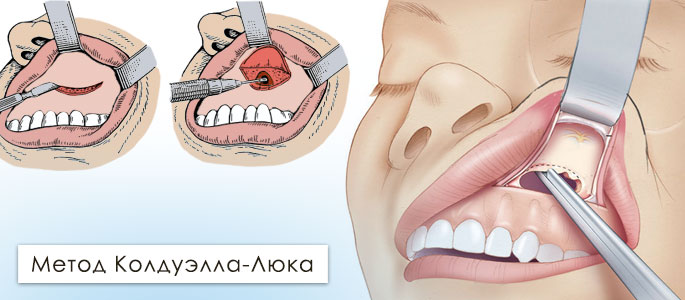 Традиционная гайморотомия