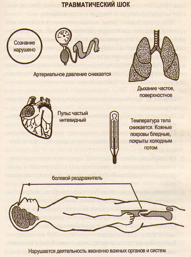 Травматический шок (схема)