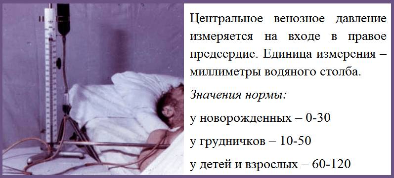 ЦВД измеряется аппаратом Вальдмана