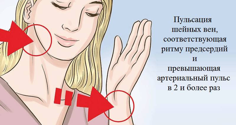 У трепыхания сердца есть патогномоничный (типичный, узнаваемый) признак