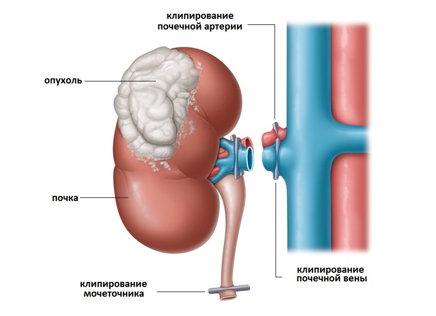 Клипирование почечной артерии