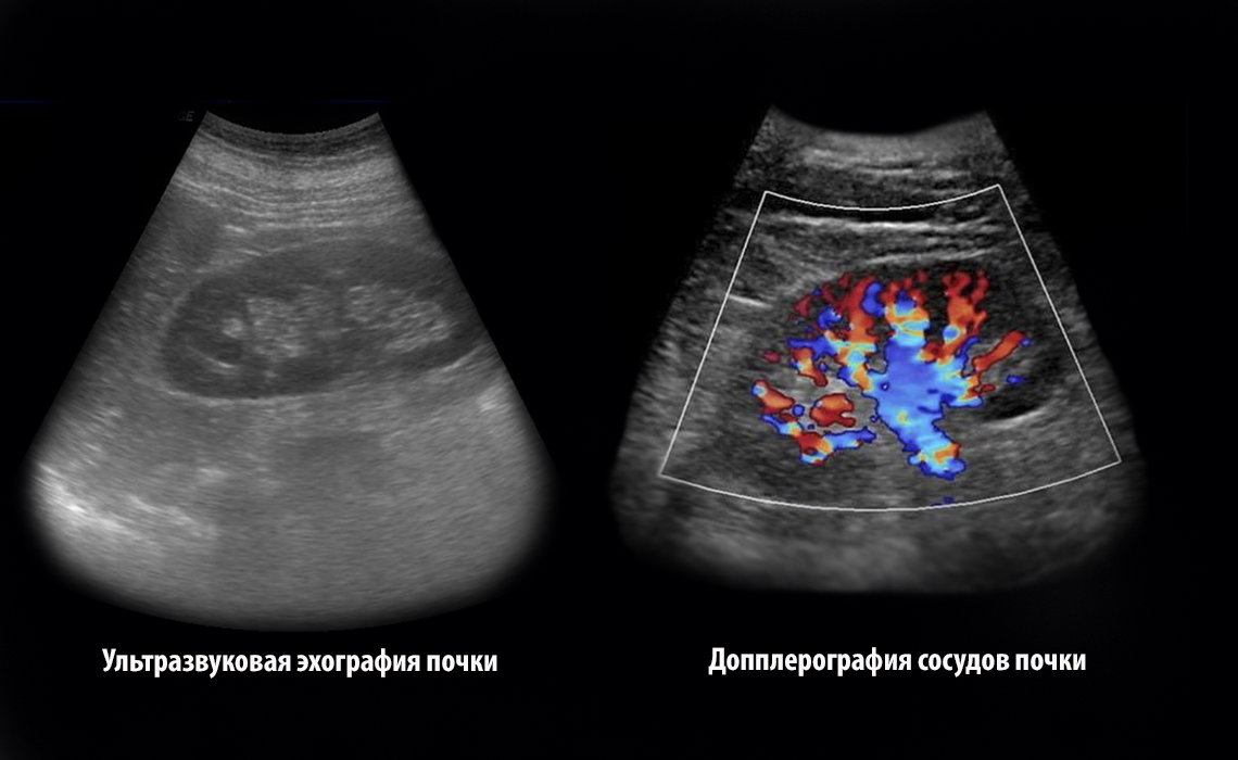 ультразвуковая эхография и допплерография почки