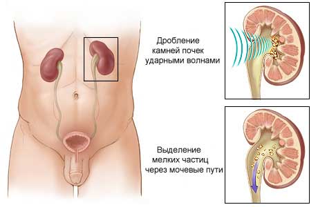 Ультразвуковое дробление камней