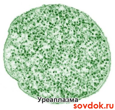 уреаплазма