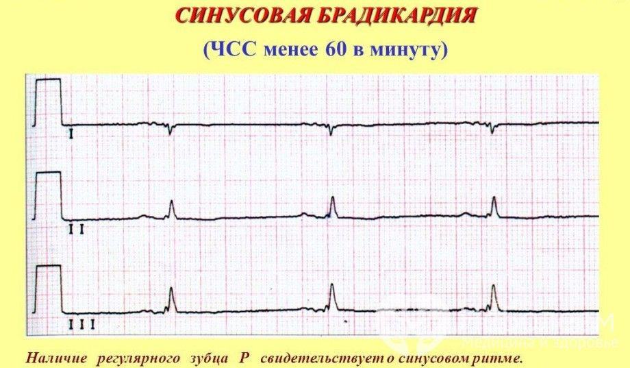 Урежение ЧСС