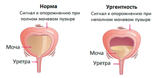 Ургентное недержание мочи