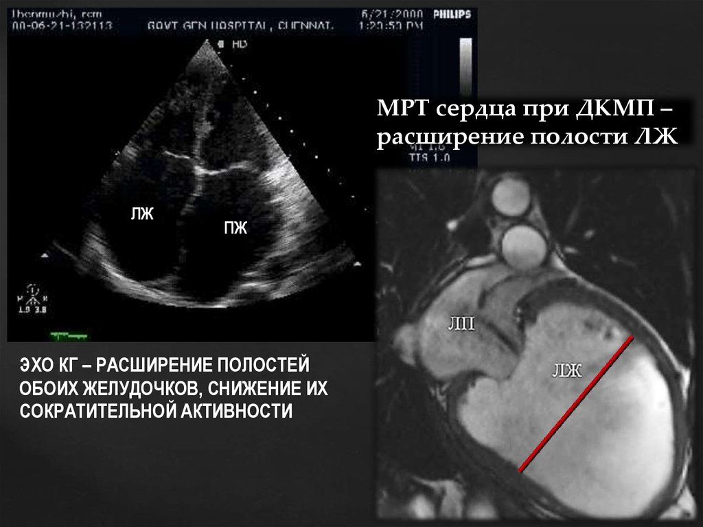 Увеличение сердечных камер на УЗИ и МРТ снимках