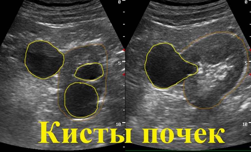 УЗИ почек