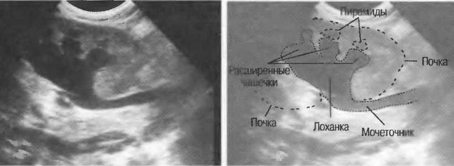 УЗИ почек с Лазиксом