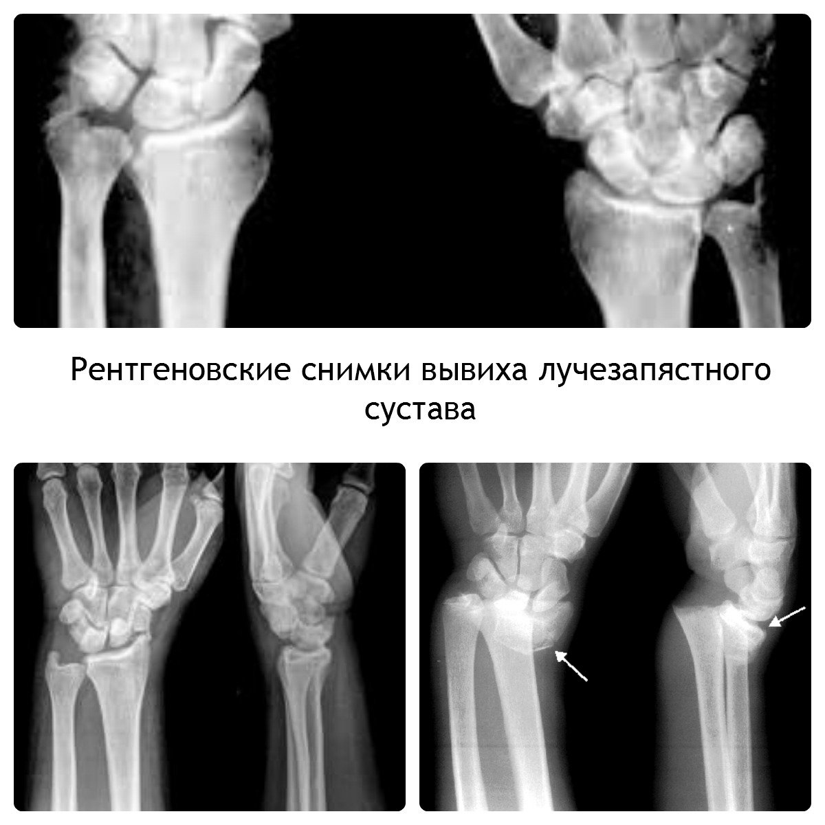Рентген вывиха лучезапястного сустава
