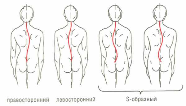 Виды искривления позвоночника