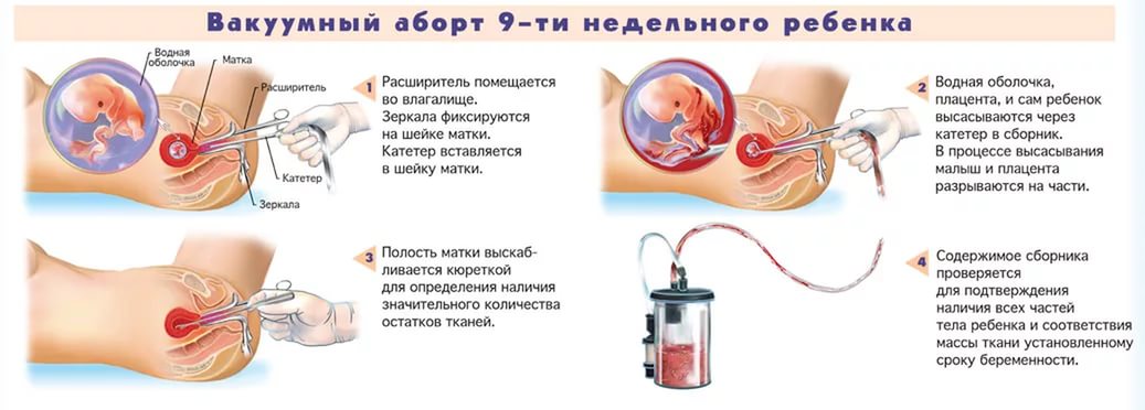 вакуум-аспирация