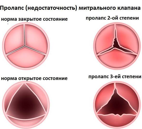 Варианты недостаточности трехстворчатого клапана
