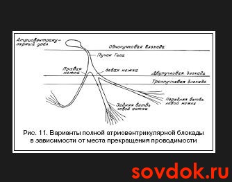 варианты полной ав блокады