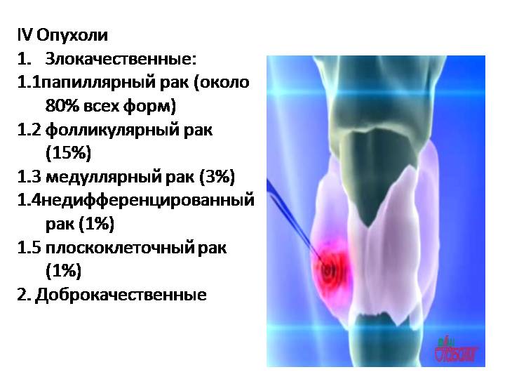 Варианты рака щитовидной железы