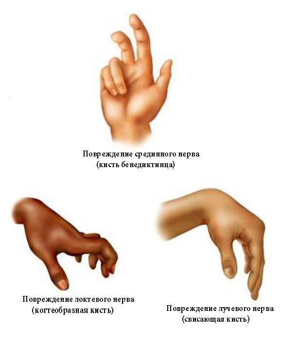 Вид кисти при поражении периферических нервов