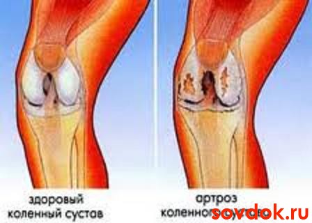 вид здорового сустава и сустава, поражённого артрозом