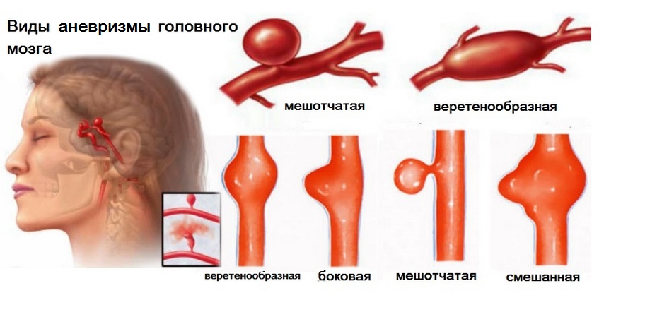Виды аневризм головного мозга