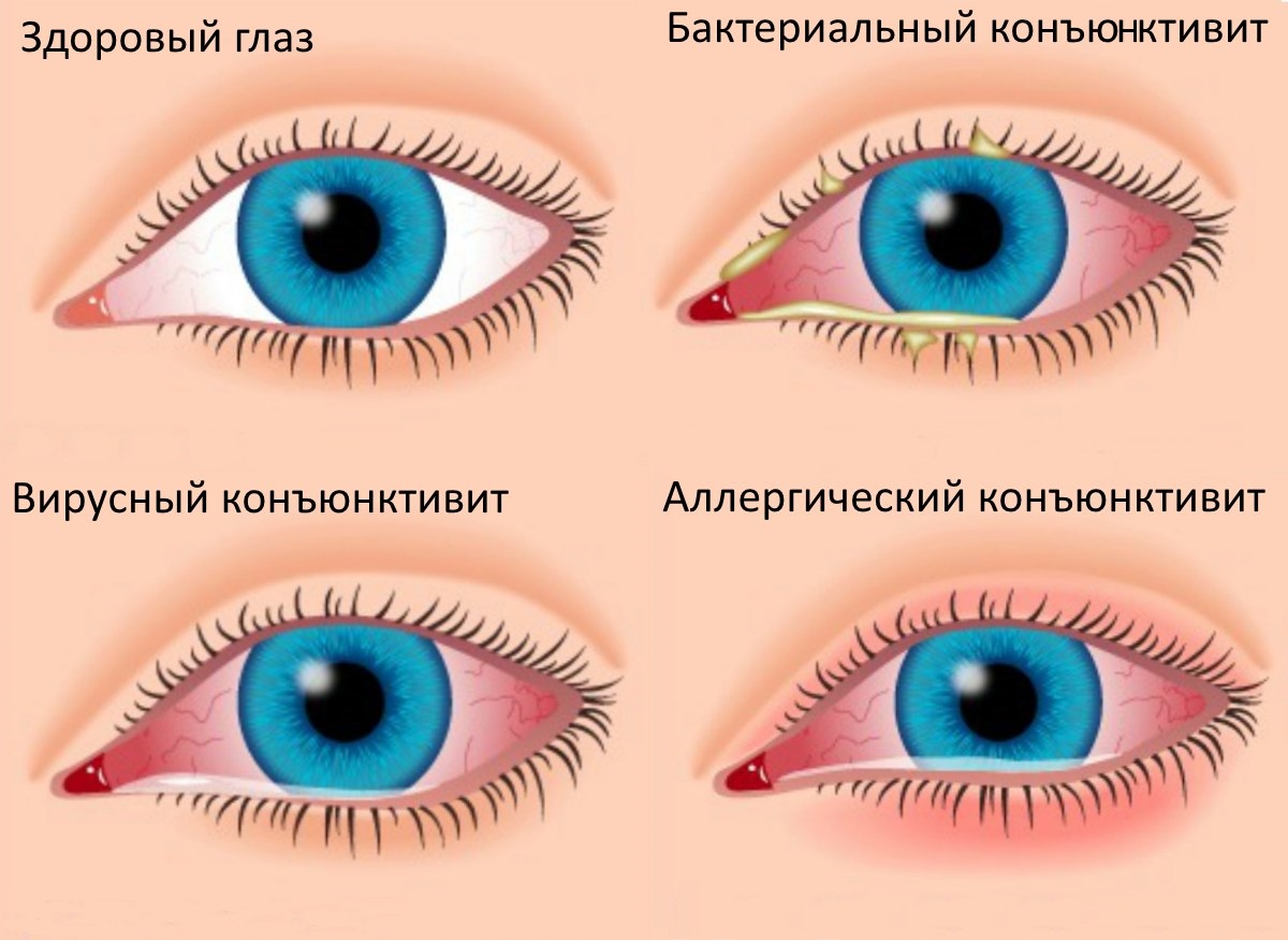 Виды конъюнктивита