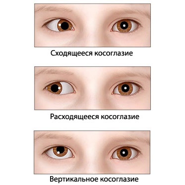 Виды косоглазий