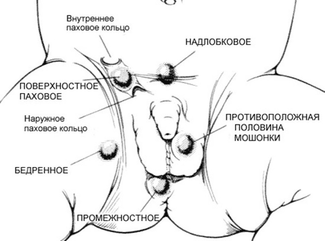 Виды крипторхизма