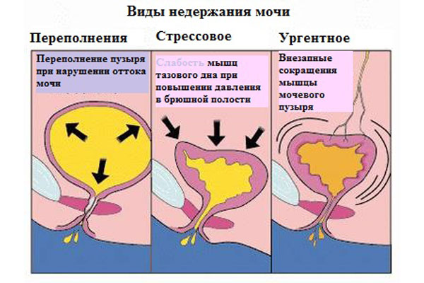 Виды недержания мочи