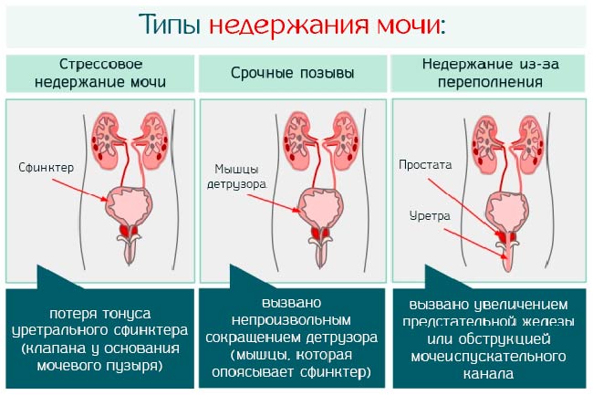 Виды недержания мочи