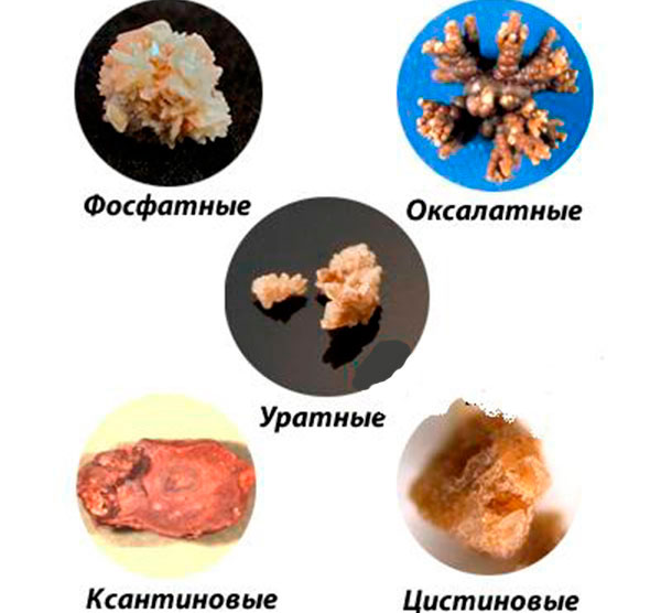Виды почечных камней