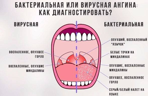 сравнение вирусной и бактериальной форм ангины