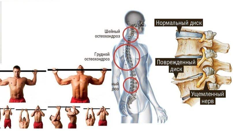 Висеть и подтягиваться на турнике очень полезно при наличии остеохондроза