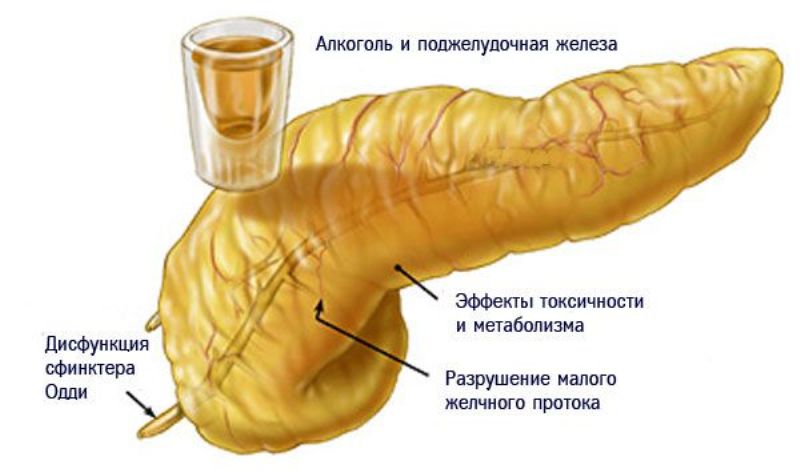 Влияние алкоголя на поджелудочную железу при панкреатите