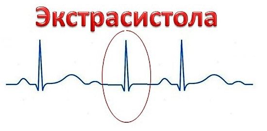 Внеочередное атипичное сокращение сердечной мышцы