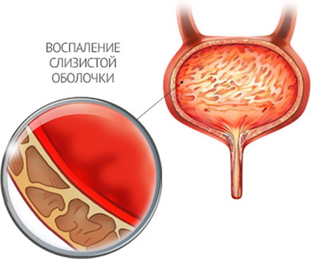 воспаление слизистой оболочки