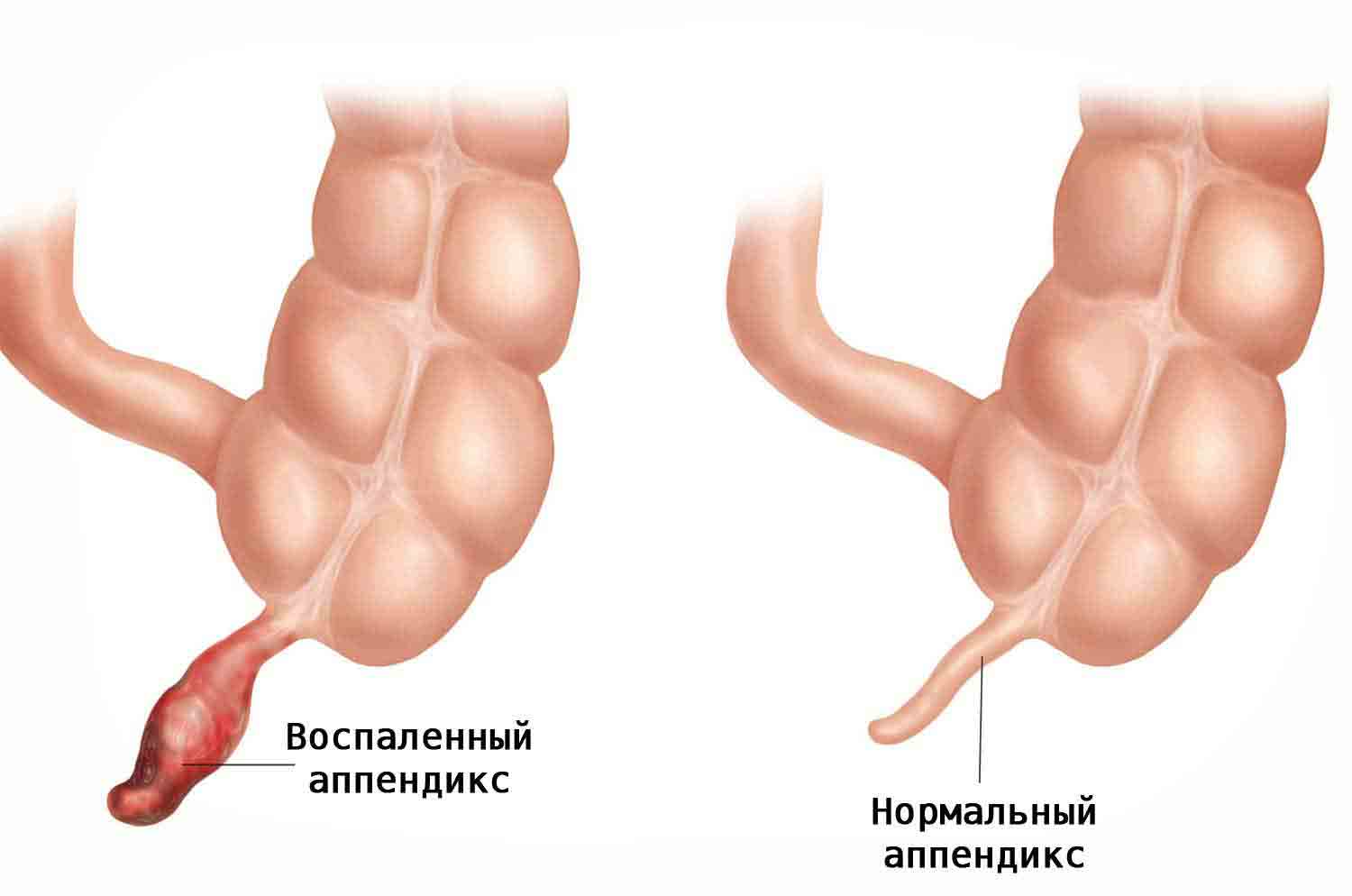 воспалённый аппендикс