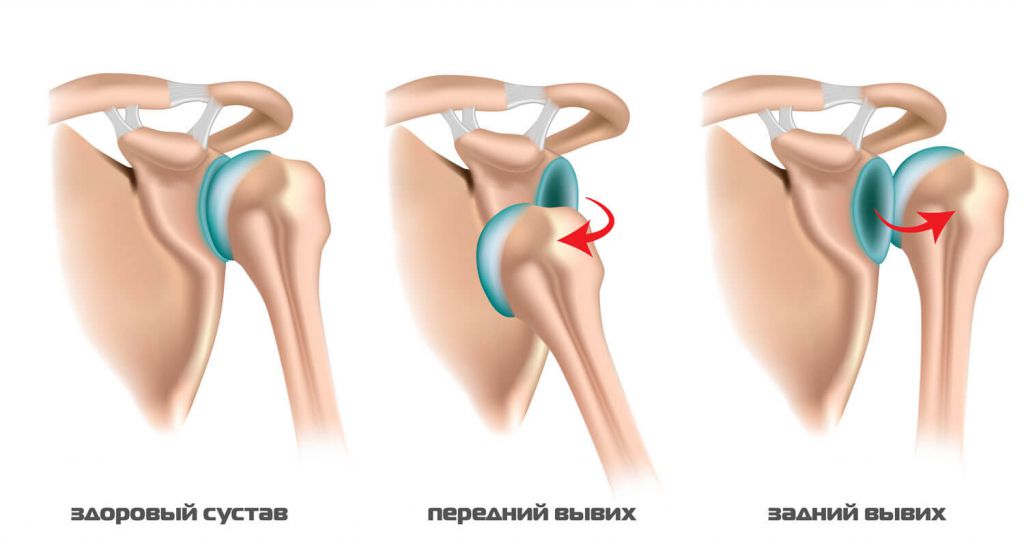Виды вывиха ключицы