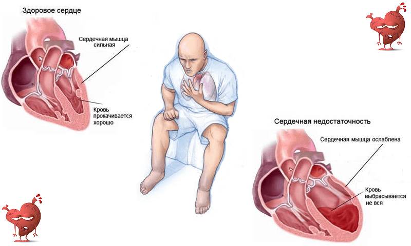 Одышка, посинение конечностей и их отеки, при ХСН — это типичные симптомы