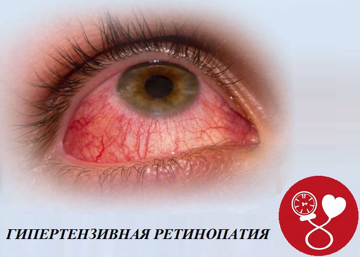 Один из органов, повреждающийся при артериальной гипертонии третьей степени — глаза
