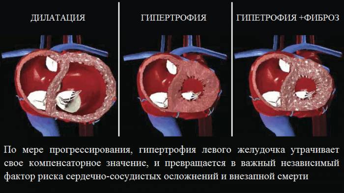 Изменения в сердце при гипертонической болезни