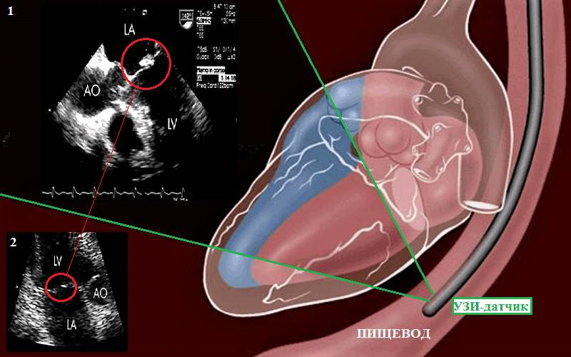 ЧПЭхоКГ (1) дает гораздо лучшую визуализацию структур сердца, чем ДЭхоКГ (2)