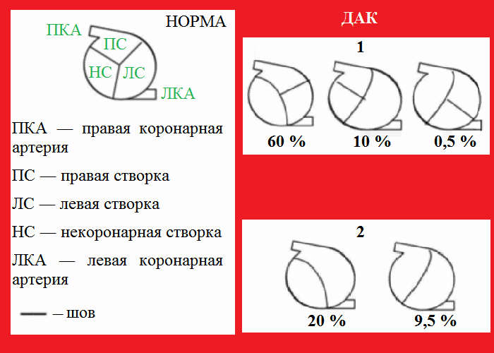 Один из вариантов классификации механических фенотипов створок ДАК