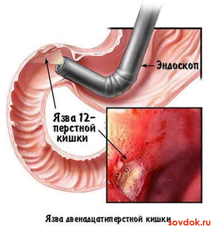 язва при фгдс