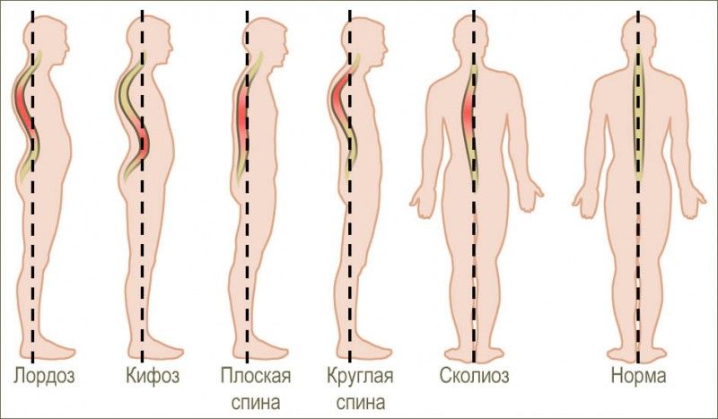 Заболевания позвоночника